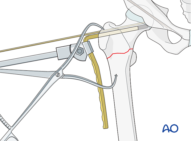 Blade insertion during fixation of an intertrochanteric fracture with an angled blade plate