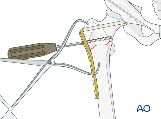 Insertion of the proximal screw in the angled blade plate for fixation of an intertrochanteric fracture