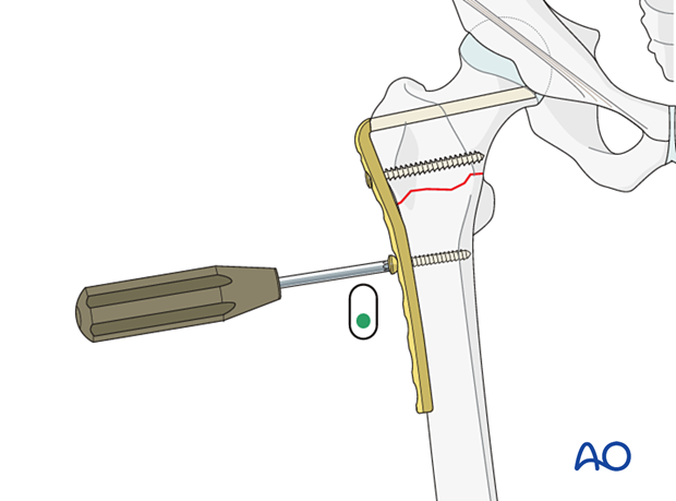 Insertion of a screw in compression mode in the angled blade plate for fixation of an intertrochanteric fracture