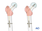 Trochanteric fracture fixed with a short intramedullary nail, with a spiral blade or lag screw