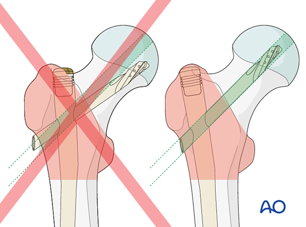 Incorrect nail and blade positioning for nail fixation of trochanteric fractures