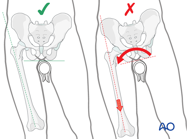 Excessive traction, in an attempt to reduce the trochanteric fracture, can lead to pelvic rotation around the perineal post of the fracture table.