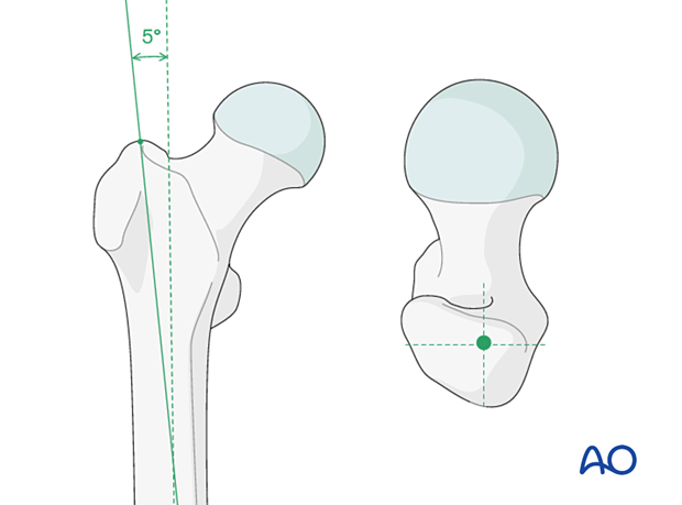 Determining the entry point for intramedullary nailing of a trochanteric fracture