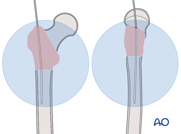 Guide-wire insertion for intramedullary nailing of a trochanteric fracture