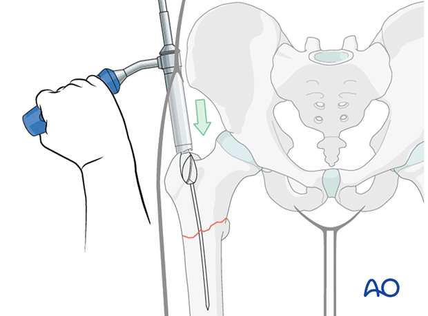 Opening the trochanter with a reamer for intramedullary nailing of a trochanteric fracture