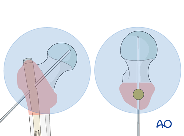 Guide-wire insertion during intramedullary nailing of a trochanteric fracture