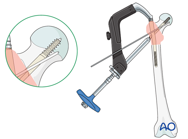 Lag screw insertion during intramedullary nailing of a trochanteric fracture