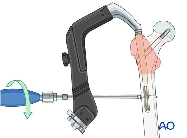 Distal locking screw insertion during intramedullary nailing of a trochanteric fracture