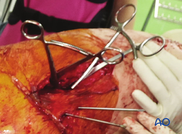 Reduction of a trochanteric fracture with pointed reduction forceps and K-wires for preliminary stabilization