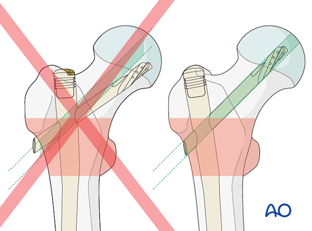 Incorrect nail and blade positioning for nail fixation of intertrochanteric fractures