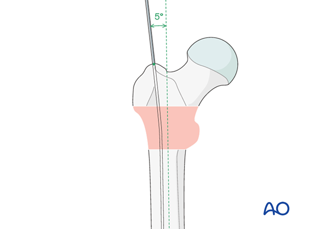 Guide-wire insertion for intramedullary nailing of a trochanteric fracture