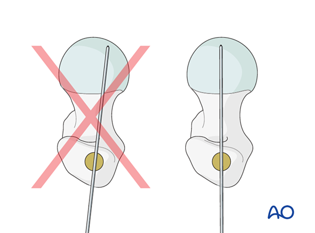 Confirming correct nail insertion depth for intramedullary nailing of an intertrochanteric fracture