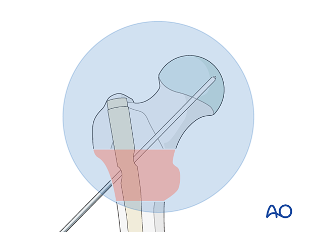 Guide-wire insertion during intramedullary nailing of an intertrochanteric fracture