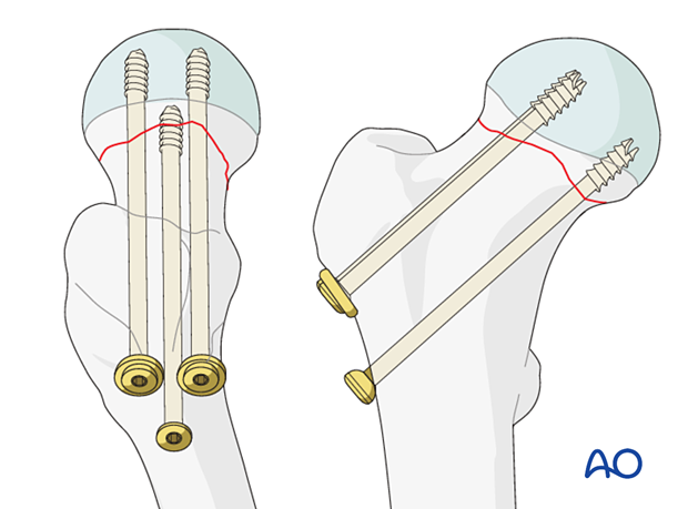 Fixation of a femoral neck fracture with cannulated screws