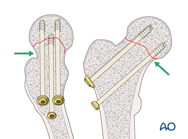 Fixation of a femoral neck fracture with cannulated screw, transsectional view showing the cortical contact on the endosteum of the proximal medial femoral neck and the posterior neck
