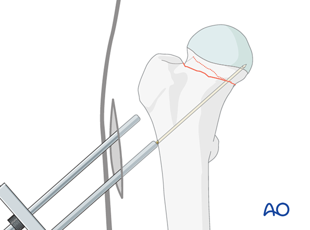 Insertion of the first guide wire for cancellous screw fixation of an impacted femoral neck fracture