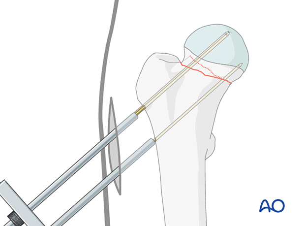 Insertion of the second and third guide wires for cancellous screw fixation of an impacted femoral neck fracture