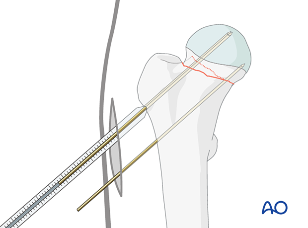 Determining the screw length for cancellous screw fixation of an impacted femoral neck fracture