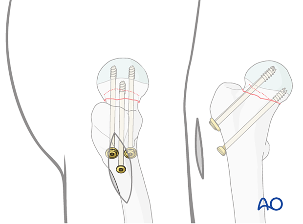 Fixation of an impacted femoral neck fracture with cannulated screws