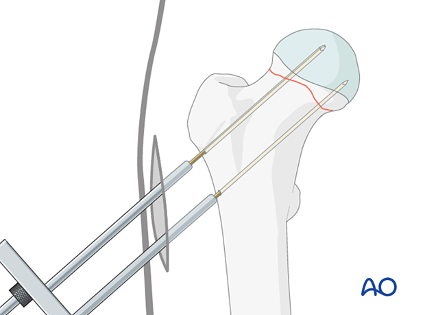 Insertion of the second and third guide wires for cancellous screw fixation of a femoral neck fracture