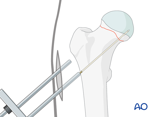 Insertion of the first guide wire for cancellous screw fixation of a femoral neck fracture