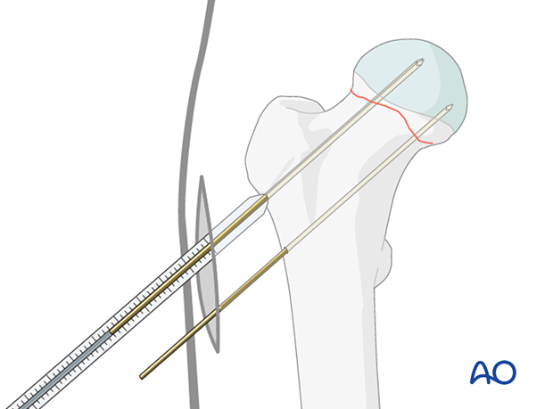 Determining the screw length for cancellous screw fixation of a femoral neck fracture