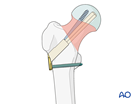 Femoral neck fracture fixed with a femoral neck system