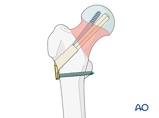 Femoral neck fracture fixed with a femoral neck system