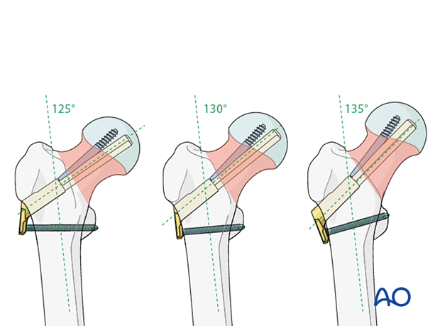 Femoral neck fractures fixed with a femoral neck system in different neck-shaft angles