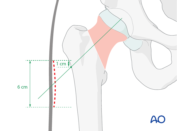 Position of the skin incision for a limited lateral approach to insert the femoral neck system