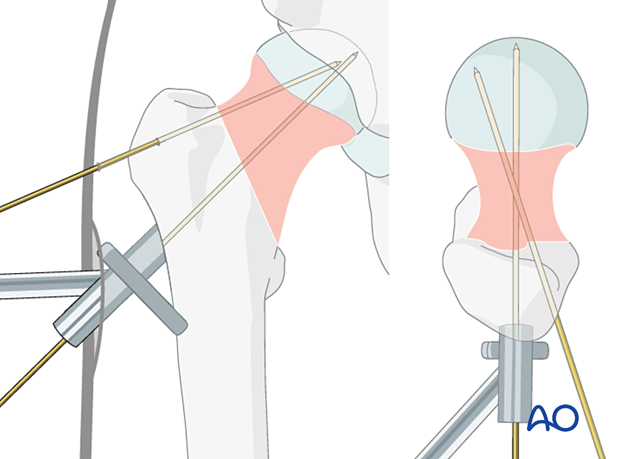 Insertion of the guide wire through the aiming device for fixation of a femoral neck fracture with a femoral neck system