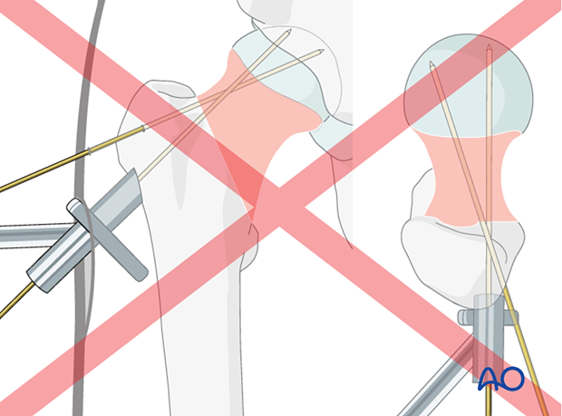 Guide wire placement superior or anterior to the head-neck axis to be avoided for optimal stabilization of femoral neck fractures with the femoral neck system