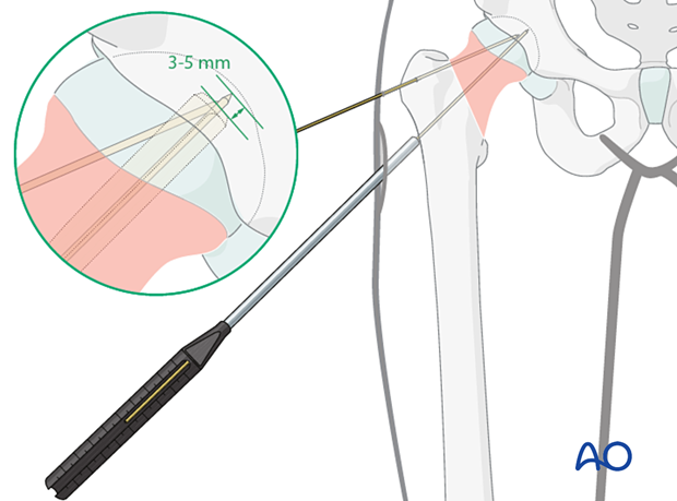 Measuring the length of the guide wire of the femoral neck system