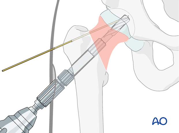 Insertion of the triple reamer for fixation of a femoral neck fracture with the femoral neck system