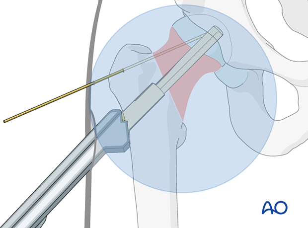 Fully inserted implant of the femoral neck system