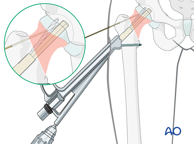 Drilling for insertion of the antirotation screw of the femoral neck system