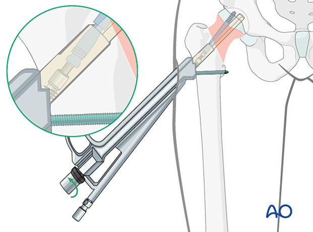 Intraoperative compression with the femoral neck system