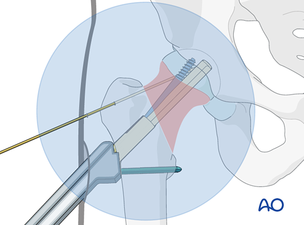 Insertion of the antirotation screw of the femoral neck system