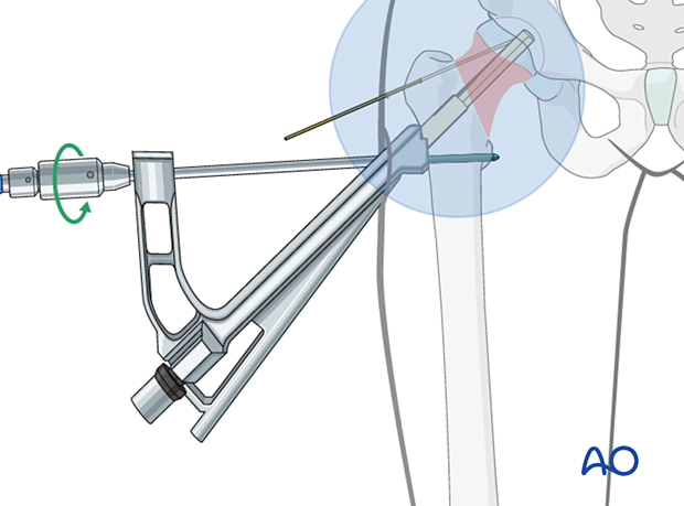 Fixation of the plate of the femoral neck system to the femoral shaft with a bicortical screw