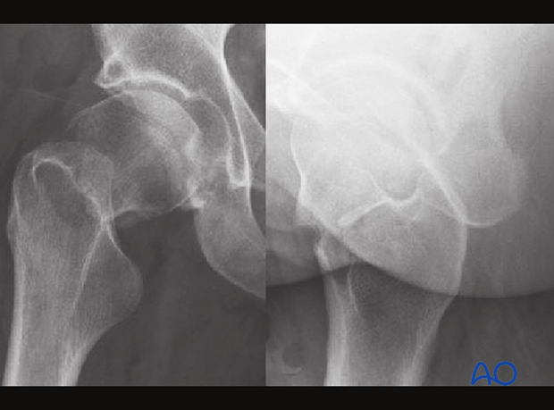 X-rays of a multifragmentary transcervical fracture