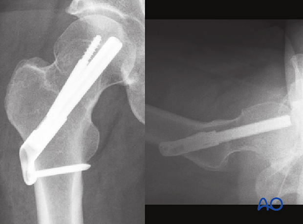 Postoperative x-rays of a multifragmentary transcervical fracture fixed with a femoral neck system
