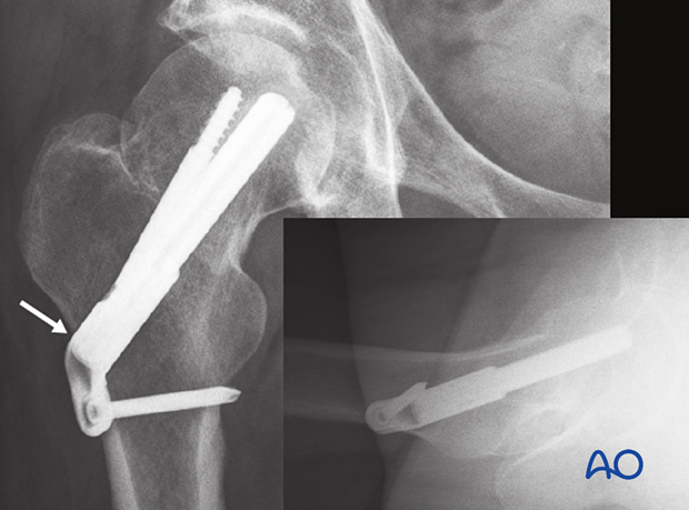 Follow-up x-rays of a multifragmentary transcervical fracture fixed with a femoral neck system