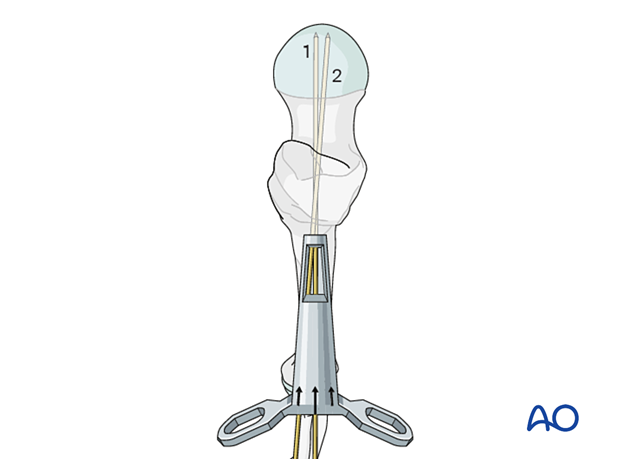 Correction guide of the femoral neck system for readjustment of guide wire position