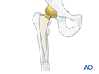 Hemiprosthesis of the hip with cemented stem