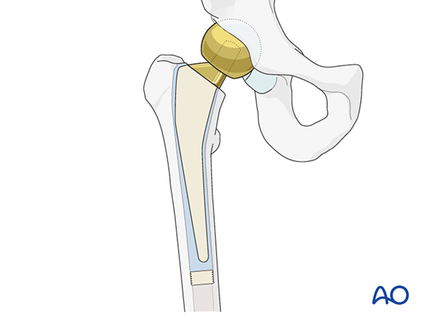 bipolar hemiarthroplasty vs total hip replacement