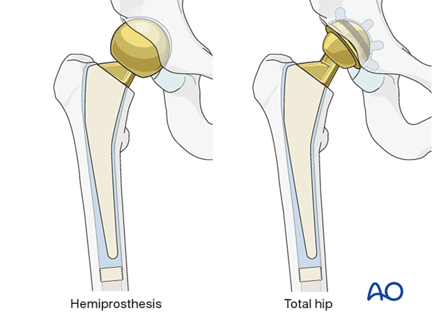 Hemiarthroplasty and total hip arthroplasty