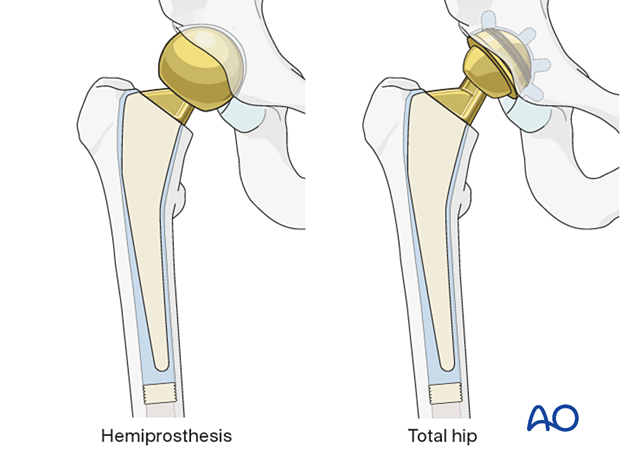 bipolar hemiarthroplasty vs total hip replacement