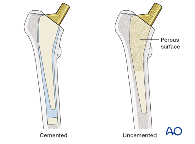 Cemented and uncemented stem for hip prosthesis
