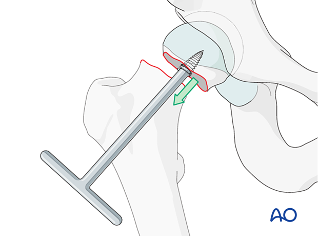 Removal of the femoral head with a threaded handle to prepare for hip arthroplasty