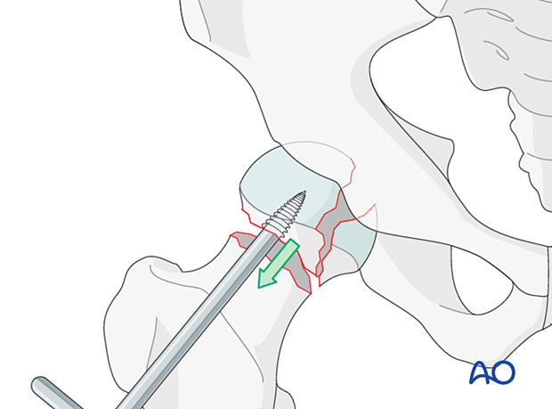 Removal of the femoral head with a threaded handle